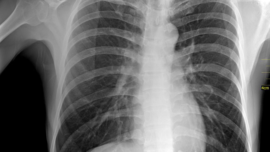 多大的结节为早期肺癌