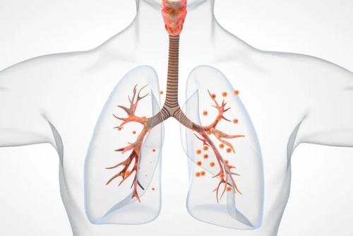 直肠癌转移到肺的症状