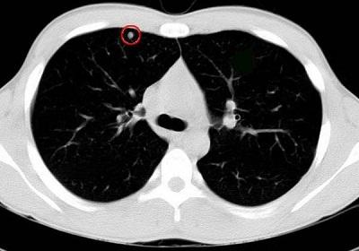肺部9毫米结节是怎么回事