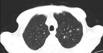 肺部结节有毛刺状是癌吗