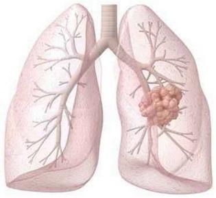   肺癌根治术后需要化疗吗？