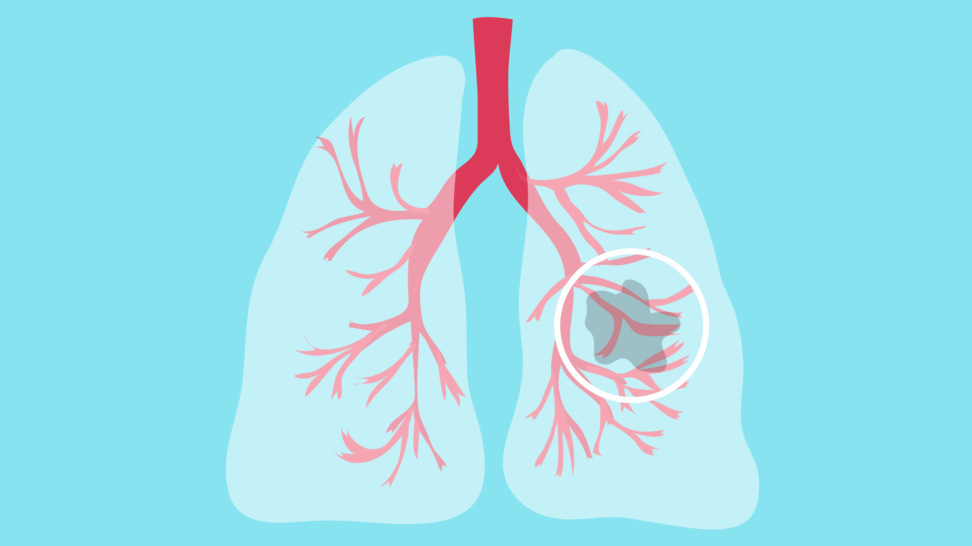肺癌全身分期检查要怎么做