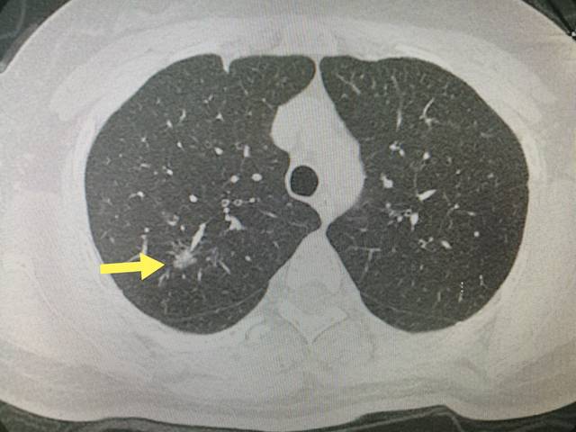 通过做CT检查就能够尽早查出肺癌吗？