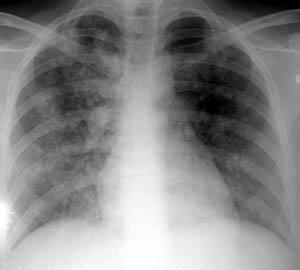 体检拍的胸片能检查出肺癌吗
