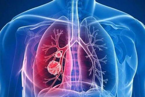 什么样的肺结节容易癌变